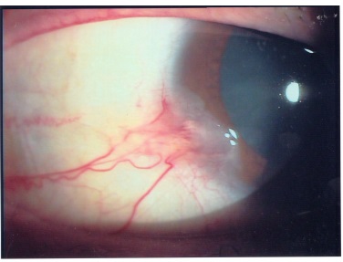 Neoplasia limbare con Mitomicina